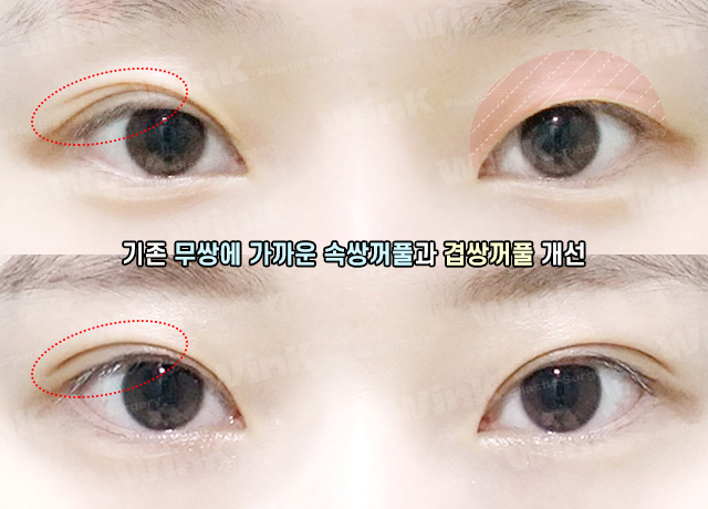Fast Return to Daily Life and Natural Lines with Wink Natural Adhesion! image 10