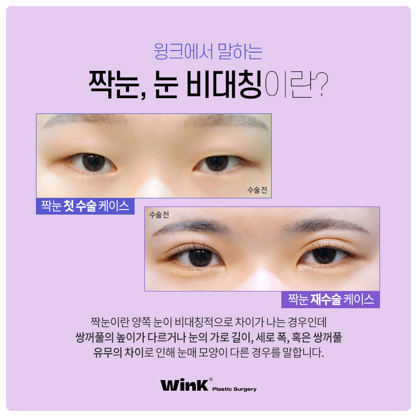 짝눈눈매교정 짝눈교정 눈매교정재수술 윙크성형외과에서 눈 비대칭 해결! 관련 이미지 2