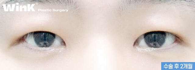 Does He Look Sleepy Because of Ptosis? At Wink Plastic Surgery, Get a Natural and Refreshed Eye Shape! image 4