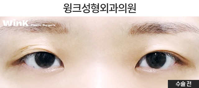 How Should Double Eyelid Surgery Be Performed for Small, Narrow Eyes? image 5