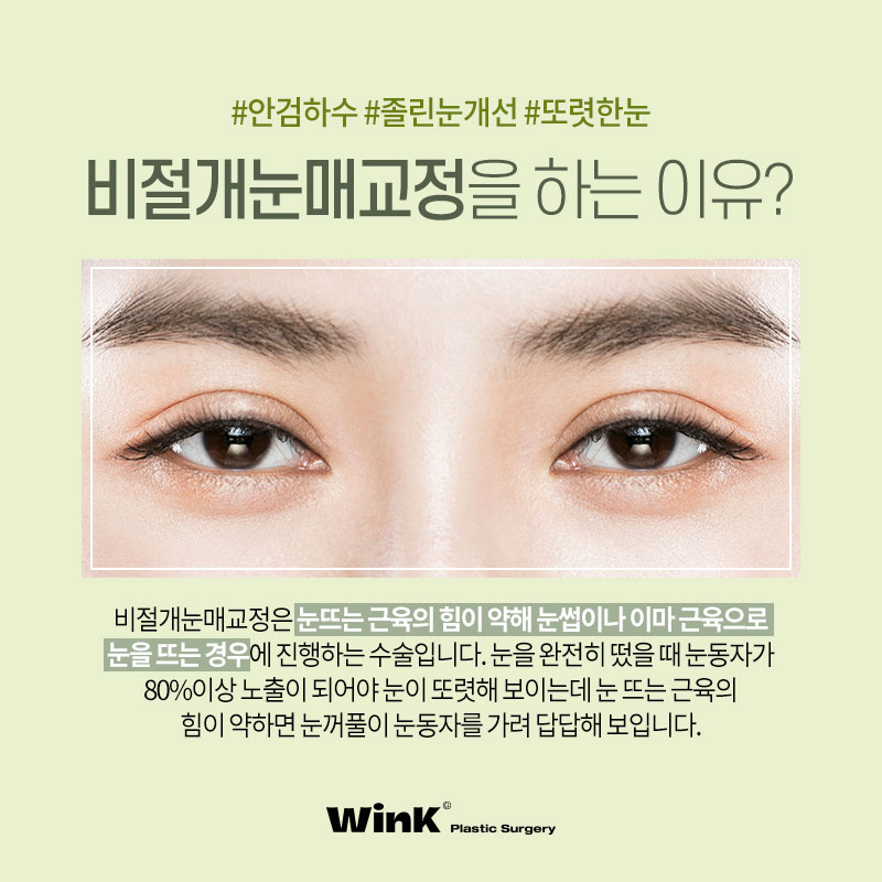 Sinsa Station Eye Correction Review | Sinsa Eye Correction Specialist | Wink Plastic Surgery | Non-Incisional Eye Correction image 2