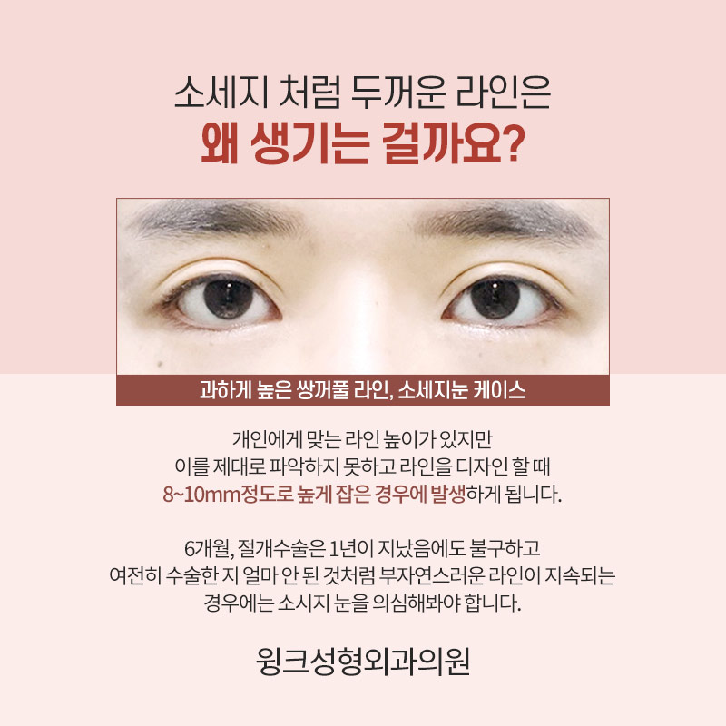 A sausage line can be improved with double-line blepharoplasty revision surgery. image 2
