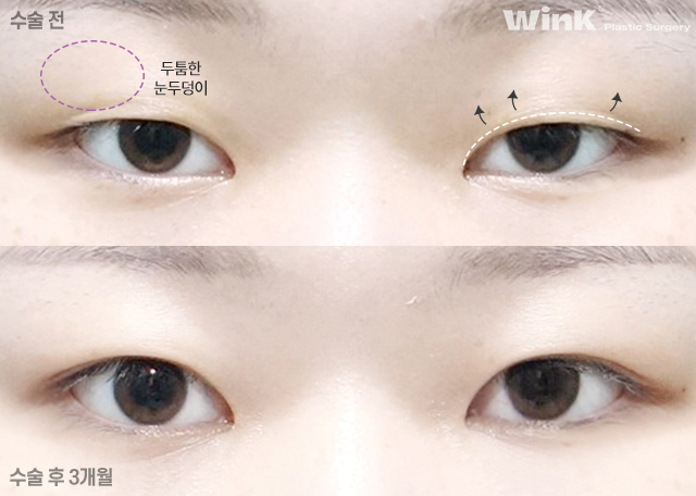 절개 쌍꺼풀 수술법에 관해 알아보겠습니다. 관련 이미지 4