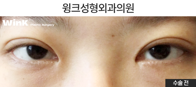 눈매교정의 효과에 대해 알아보겠습니다. 관련 이미지 2