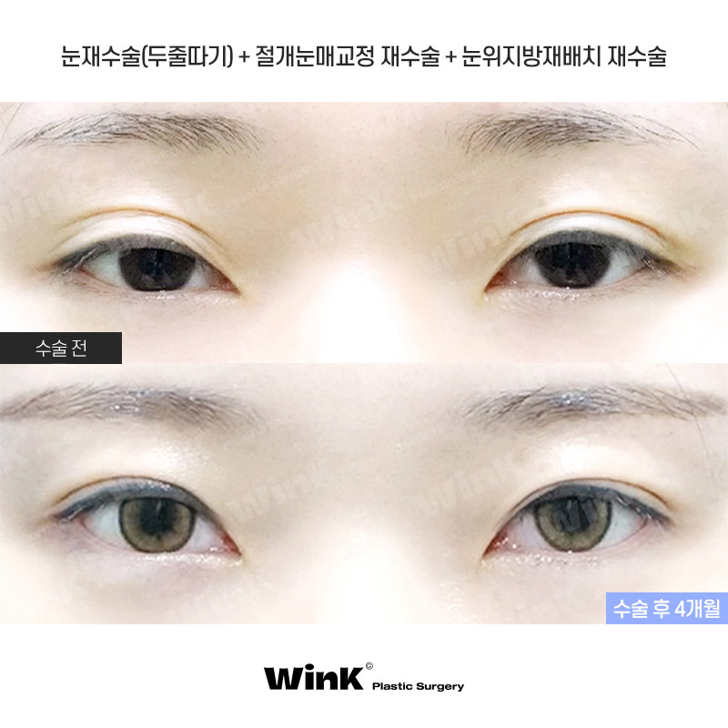 Lowering the Double Eyelid Line: Making Thick Double Eyelids (Sausage Eyes) Look Natural with a Two-Line Revision Surgery! image 1