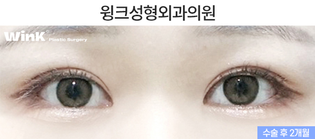 자연유착 쌍꺼풀에 대해 알아보겠습니다. 관련 이미지 3