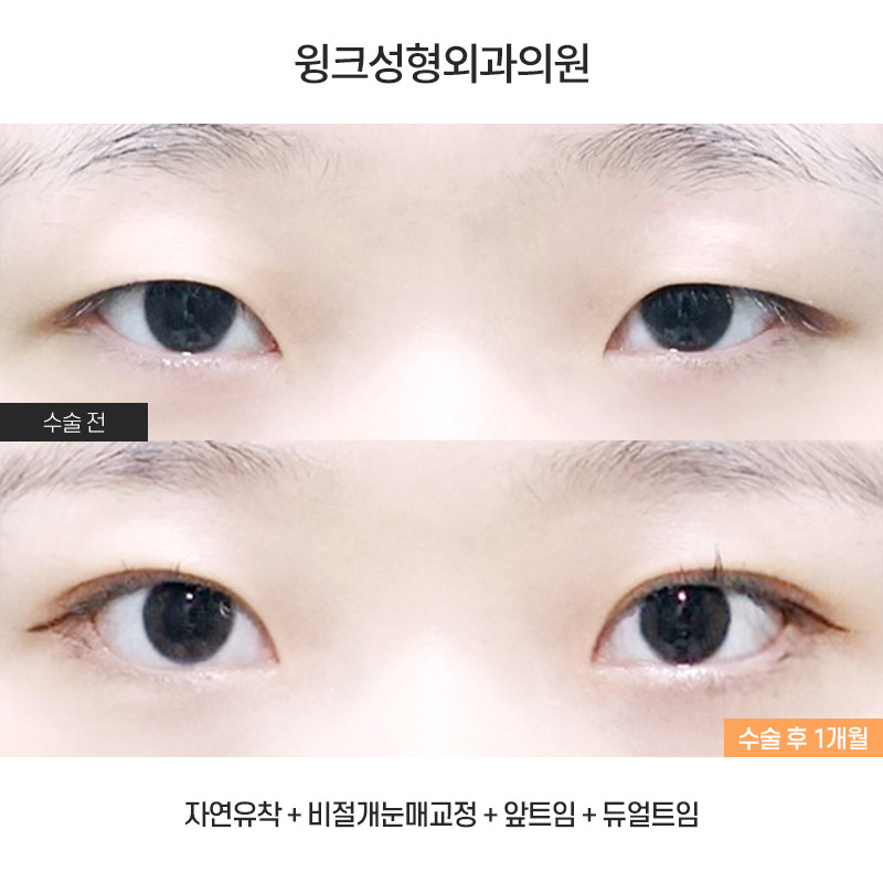 인라인 자연유착 쌍꺼풀 수술에 대해 알아볼까요? 관련 이미지 1