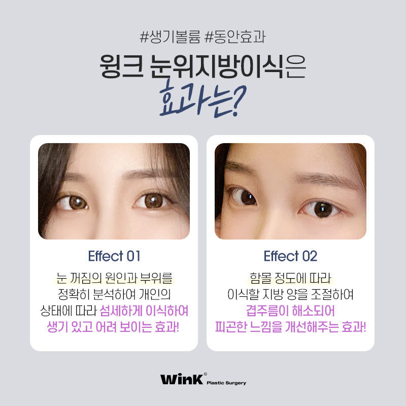 Let’s Restore Volume to Sunken Eyes with Wink Plastic Surgery’s Upper Eyelid Fat Grafting image 6