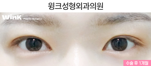 Let’s Take a Look at Double Eyelid Surgery for Droopy Eyes. image 6