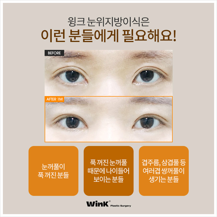 If You're Curious About Upper Eyelid Fat Grafting Reviews: Wink Plastic Surgery, Sinsa Upper Eyelid Fat Grafting Price, and Before-and-After for Hollow Eyes image 5