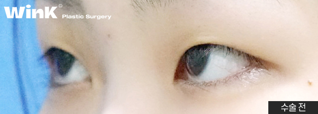 The Key to Ptosis Correction Is Proper Iris Exposure! image 5