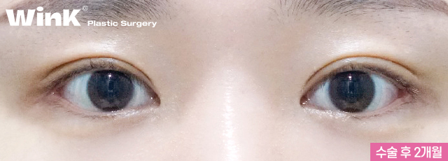 윙크 자연유착재수술로 자연스럽고 확실한 고정! 관련 이미지 5