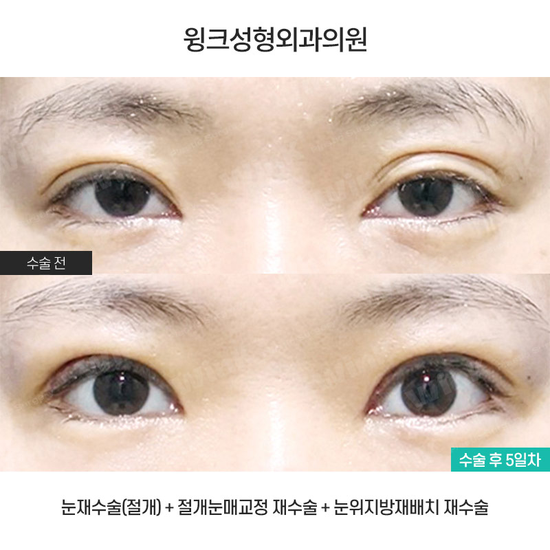 마지막 눈 성형, 눈매교정으로 또렷하게 개선해 드리는 윙크성형외과 눈재수술! 관련 이미지 1