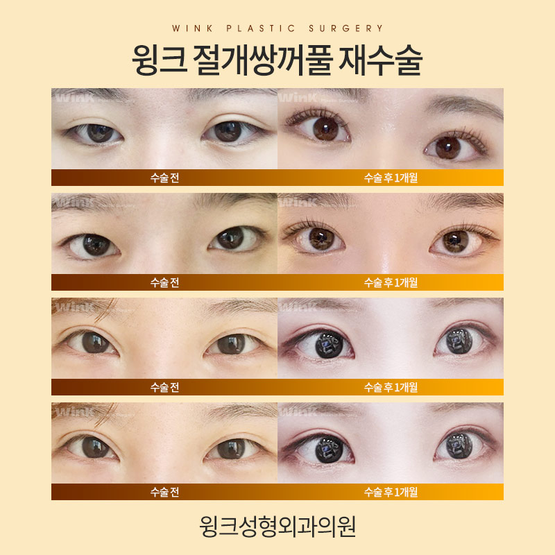 절개 쌍수 재수술에 대해 알아보겠습니다. 관련 이미지 7