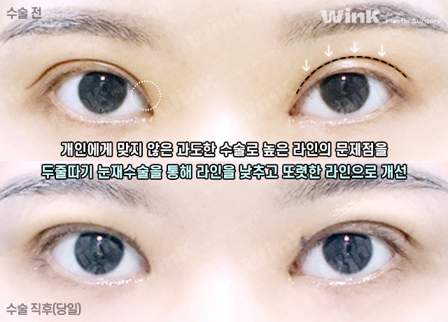 높고 깊은 고정으로 생긴 소세지눈, 윙크성형외과 두줄따기로 라인낮추기! 관련 이미지 5