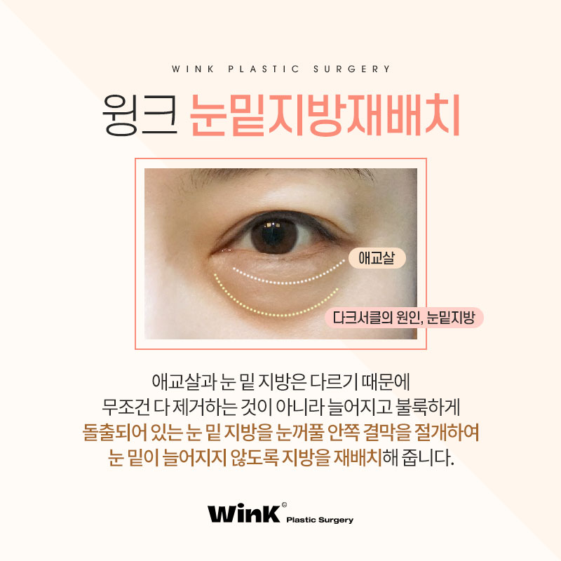 A Dull Impression: WINK Plastic Surgery’s Under-Eye Fat Repositioning for a Brighter Look, Sinsa Under-Eye Fat Repositioning, Under-Eye Fat Repositioning Pain image 3