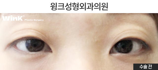 자연유착 쌍꺼풀에 대해 알아보겠습니다. 관련 이미지 5