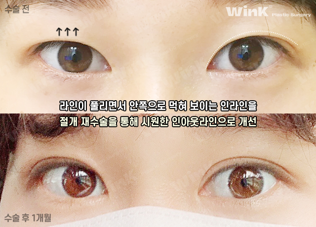 If You’re Looking Into Revision Double Eyelid Surgery, Visit Wink Plastic Surgery for Beauty and Function! image 7