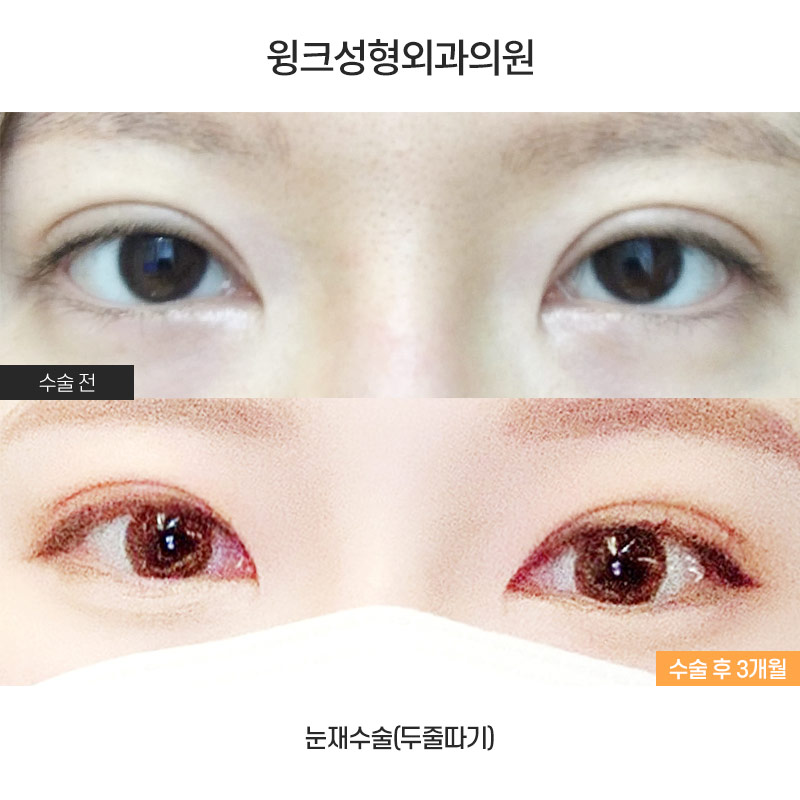 소세지눈 재수술, 두줄따기로 라인 낮추기 관련 이미지 1
