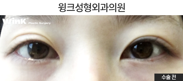 꼬막눈 쌍수도 시원하게! 눈성형 중점 진료 윙크성형외과 관련 이미지 5