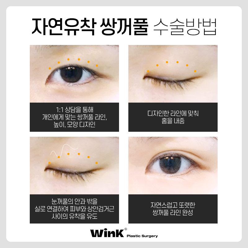 신사역쌍수잘하는곳? 윙크성형외과 자연유착쌍꺼풀후기 관련 이미지 3