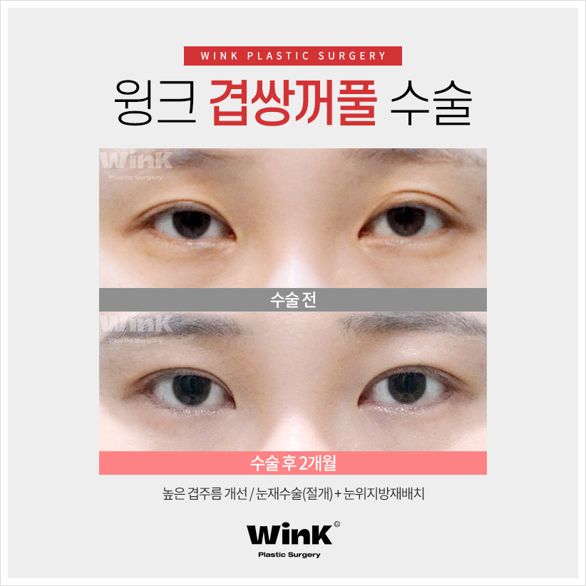 겹주름쌍꺼풀 겹쌍 쌍꺼풀여러겹 겹쌍꺼풀수술은 윙크성형외과! 관련 이미지 5
