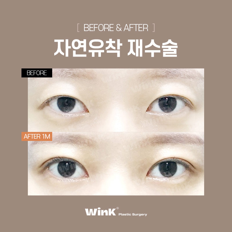 Wink Plastic Surgery’s Natural Adhesion Revision Surgery to Put an End to Further Failures! image 7