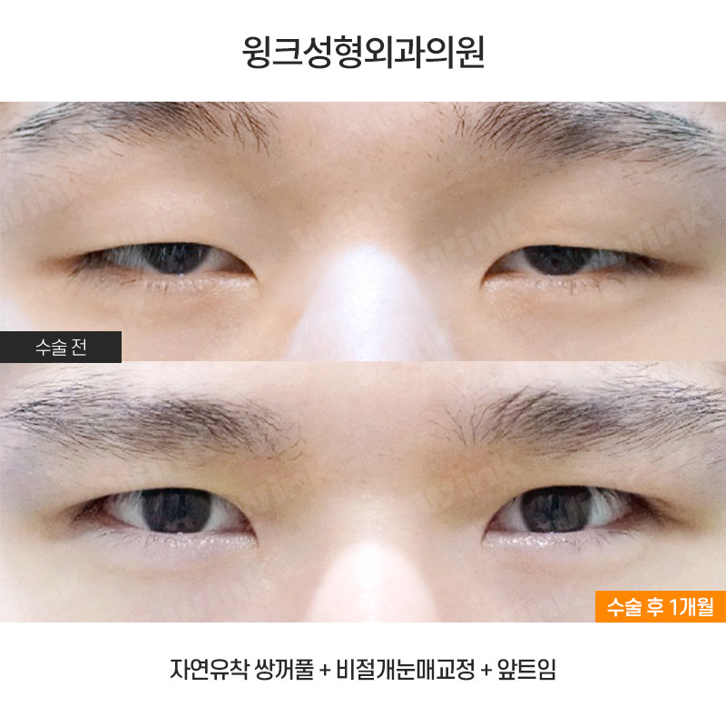 남자 속쌍커풀 수술에 대해 알아보자 관련 이미지 1