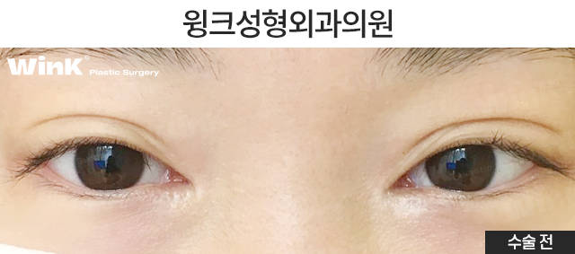 Let’s Learn About Epicanthoplasty Revision and Reconstruction image 2