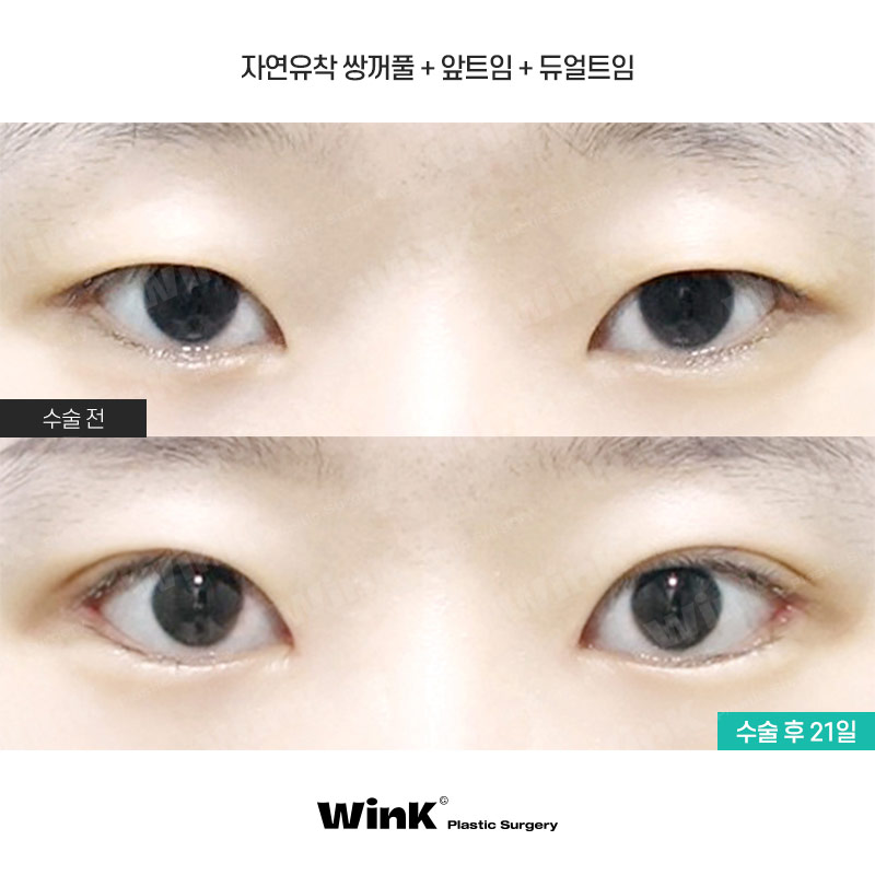 자연스러운 쌍수 맛집 찾고 있다면 윙크성형외과 자연유착쌍꺼풀! 관련 이미지 1