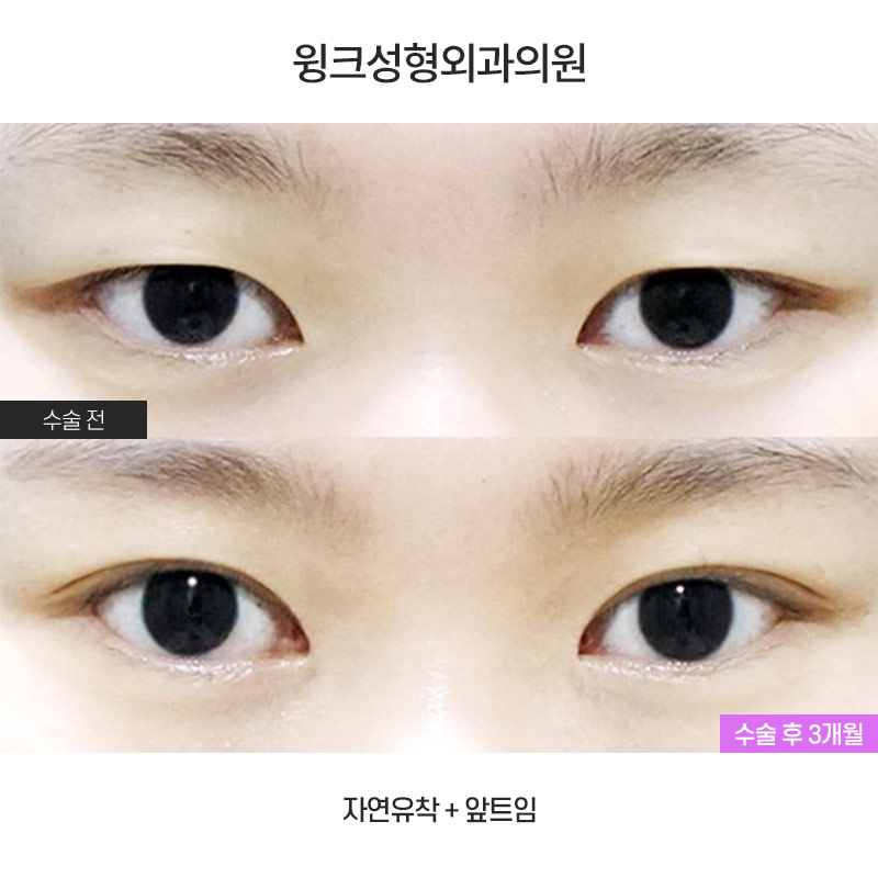 I Would Like to Talk About Natural Adhesion Double Eyelid Surgery. image 1