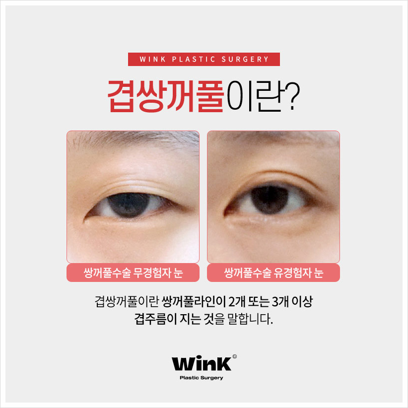 겹주름쌍꺼풀 겹쌍 쌍꺼풀여러겹 겹쌍꺼풀수술은 윙크성형외과! 관련 이미지 2