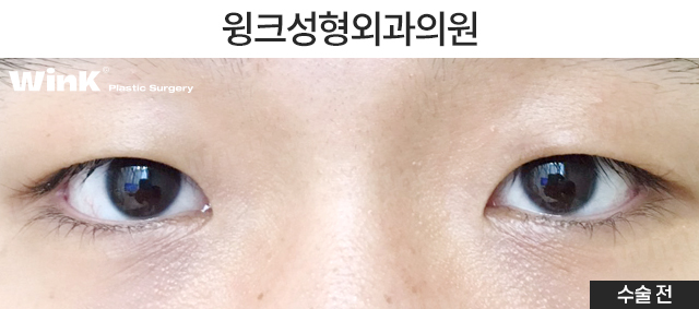 Let's Learn About Male Eye Correction and Eye Plastic Surgery image 2