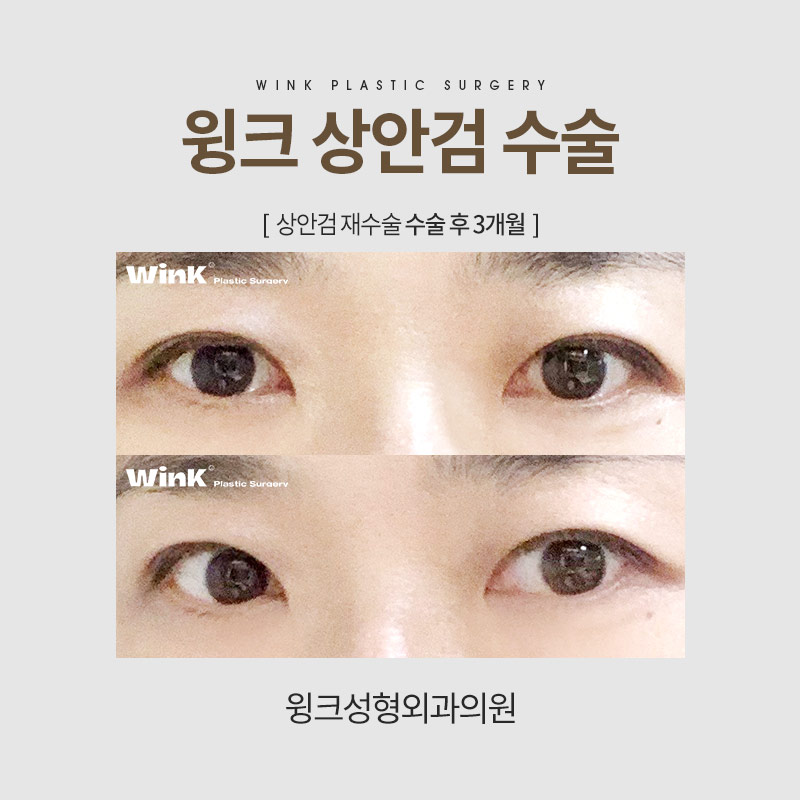 If You Want Upper Eyelid Surgery to Look Natural image 8
