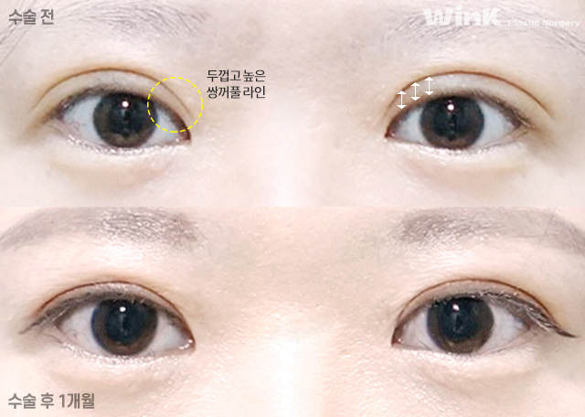 두줄따기 절개 눈재수술로 소세지눈에서 벗어나 볼까요? 관련 이미지 4