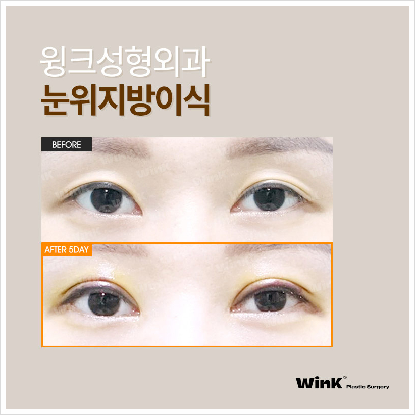 If You're Curious About Upper Eyelid Fat Grafting Reviews: Wink Plastic Surgery, Sinsa Upper Eyelid Fat Grafting Price, and Before-and-After for Hollow Eyes image 4