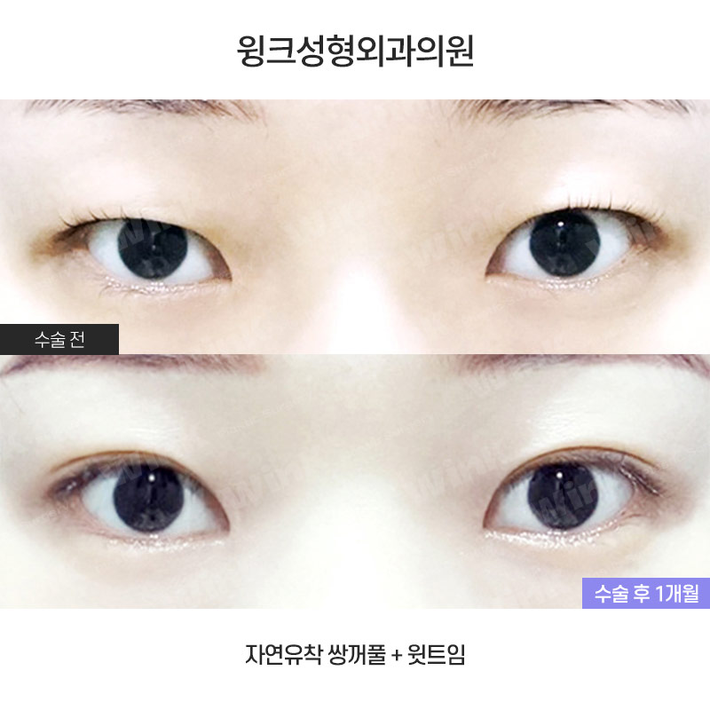 Let’s Take a Look at the Changes and Effects Before and After Upper Epicanthoplasty image 1