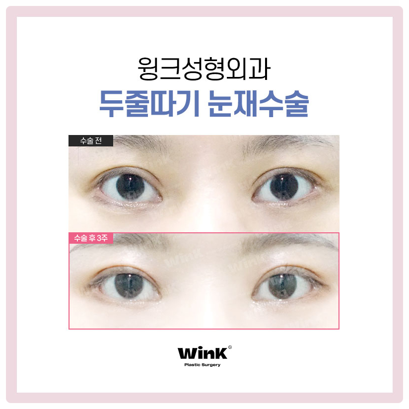 Revision Surgery for Sausage-Like Double Eyelids: Lowering the Double-Eyelid Line, Wink Plastic Surgery Sausage-Eye Revision Review image 6