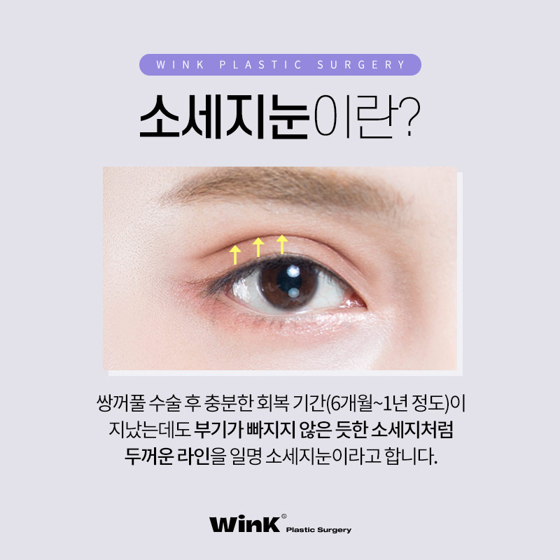 두껍고 높은 소세지눈? 윙크성형외과 두줄따기로 라인낮추기! 관련 이미지 2