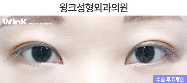 Let’s Take a Look at the Changes and Effects Before and After Upper Epicanthoplasty image 6