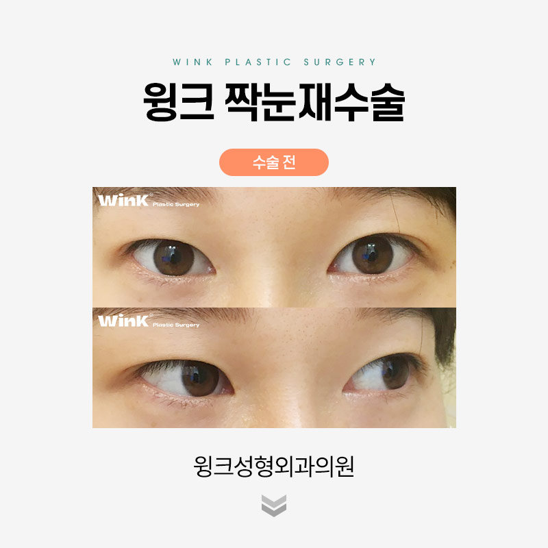 짝눈 쌍꺼풀 재수술에 관해 알아보겠습니다. 관련 이미지 7