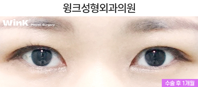 I Would Like to Talk About Natural Adhesion Double Eyelid Surgery. image 6