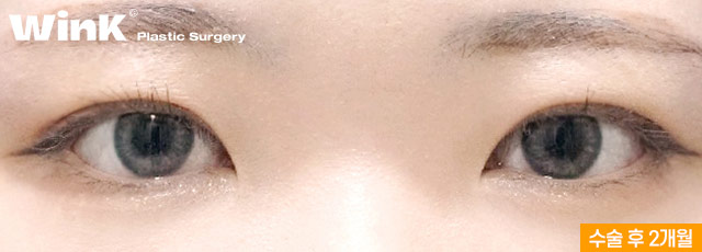 Is Fast Recovery Only Possible with Non-Incisional Surgery? At Wink Plastic Surgery, Incisional Double Eyelid Surgery Can Also Return You to Daily Life Quickly! image 6