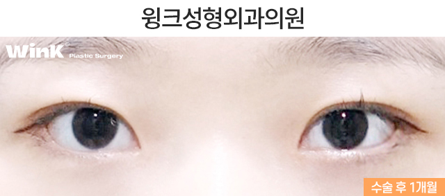 인라인 자연유착 쌍꺼풀 수술에 대해 알아볼까요? 관련 이미지 3