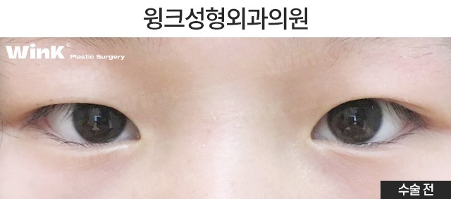 중학생 쌍커풀수술에 대해 알아볼까요? 관련 이미지 10