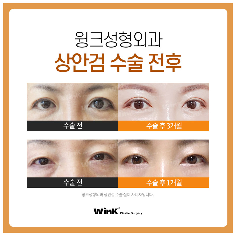 상안검안검내반 속눈썹찔림수술  윙크성형외과 안검내반수술후기 관련 이미지 7