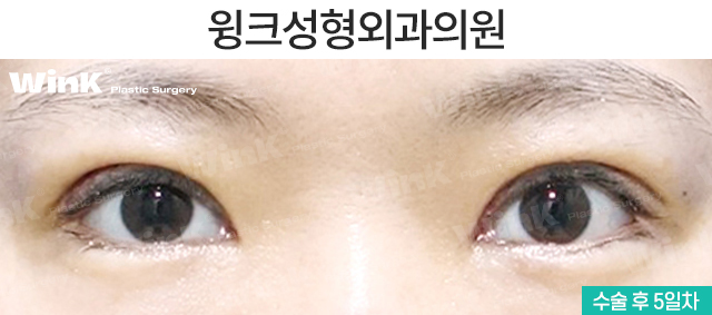 마지막 눈 성형, 눈매교정으로 또렷하게 개선해 드리는 윙크성형외과 눈재수술! 관련 이미지 3