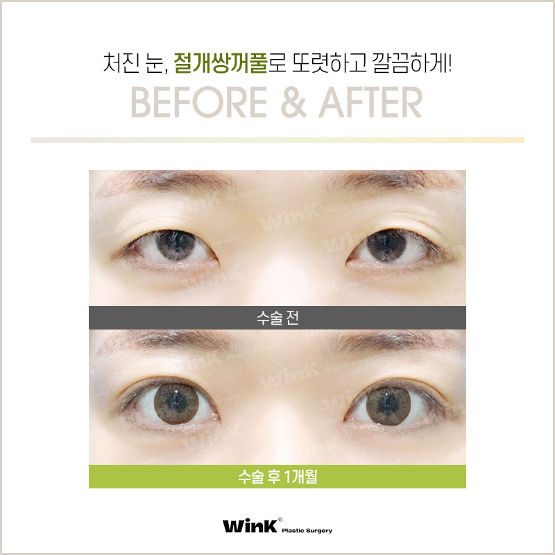 What Are the Differences Between Natural Adhesion and Buried Double Eyelid Surgery? Everything You Need to Know About Natural Adhesion, as Told by Wink Plastic Surgery! image 5