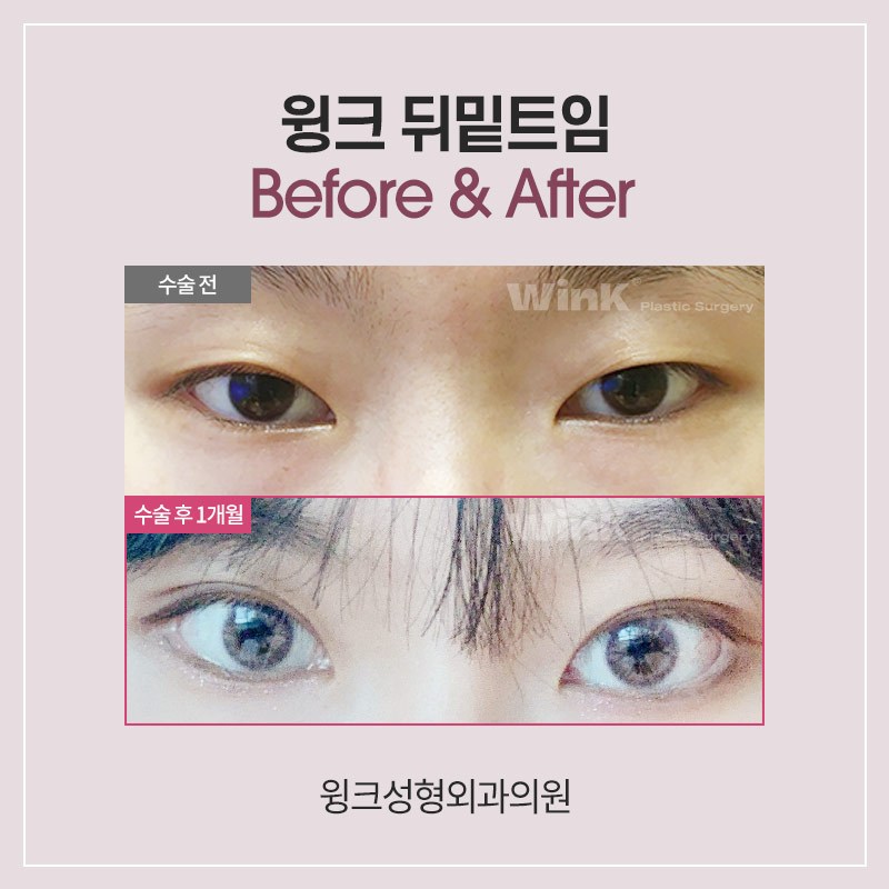 Shall We Learn About Canthoplasty and Dual Canthoplasty? image 4