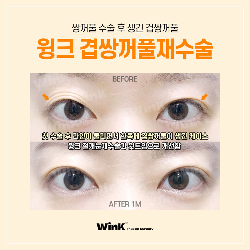 Double Eyelid Surgery Left You with a Double Fold? Fix It Neatly with Revision Surgery for Double Folds at Wink Plastic Surgery! image 7